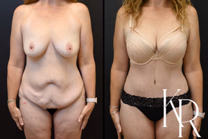 Tummy tuck before and after photo, front view