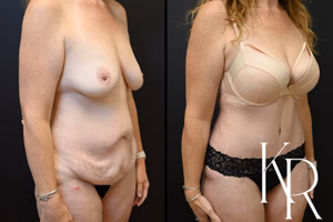 Tummy tuck before and after photo, oblique view