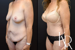 Tummy tuck before and after photo, oblique view
