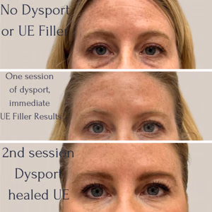 Under-eye correction before and after photo, multiple views