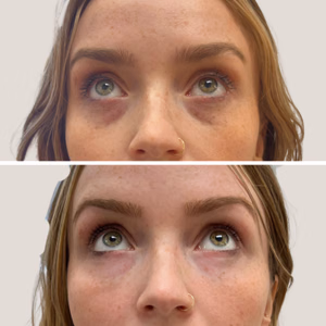 Under-eye correction before and after photo, close-up view
