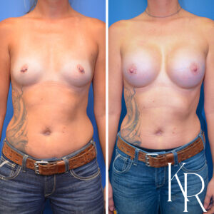 Before and after breast augmentation