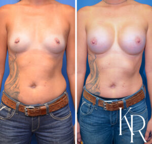 Before and after breast augmentation