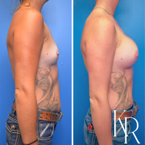 Before and after breast augmentation