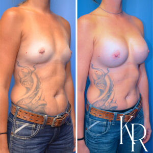 Before and after breast augmentation