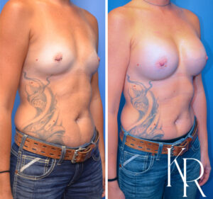 Before and after breast augmentation