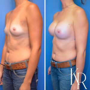 Before and after breast augmentation