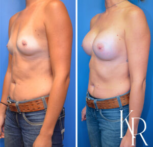 Before and after breast augmentation