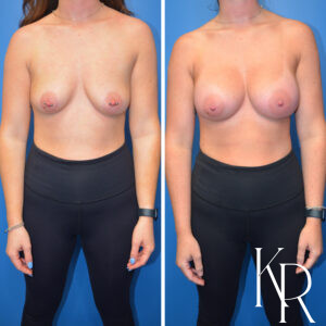 Before and after breast augmentation