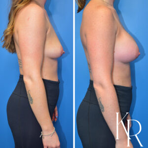 Before and after breast augmentation