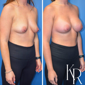 Before and after breast augmentation