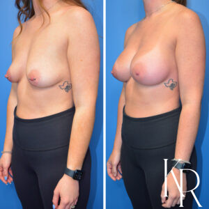 Before and after breast augmentation