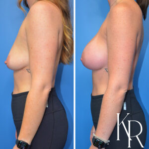Before and after breast augmentation