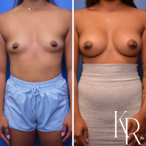 Before and after breast augmentation