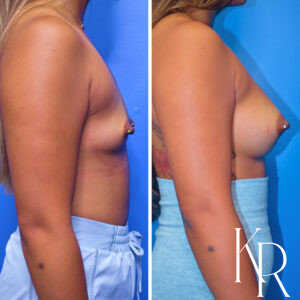 Before and after breast augmentation