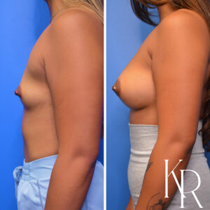 Before and after breast augmentation