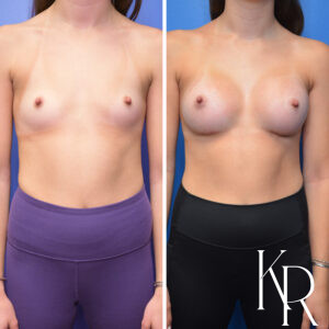 Before and after breast augmentation
