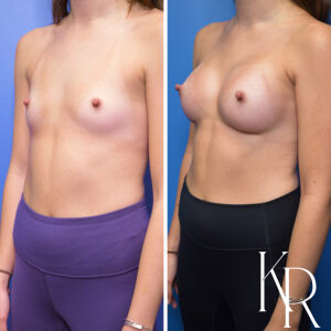 Before and after breast augmentation