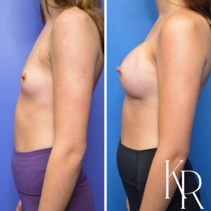Before and after breast augmentation