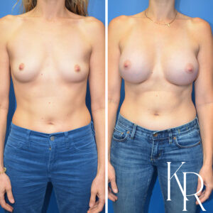 Before and after breast augmentation
