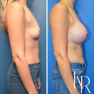 Before and after breast augmentation