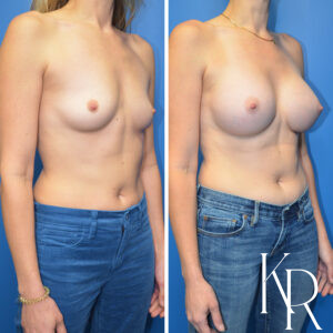 Before and after breast augmentation