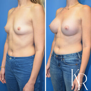 Before and after breast augmentation