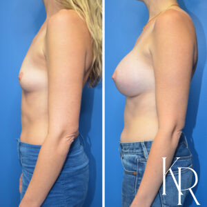 Before and after breast augmentation
