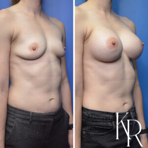 Before and after breast augmentation