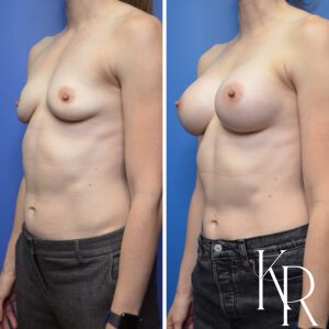 Before and after breast augmentation