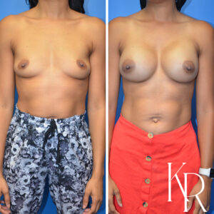 Before and after breast augmentation