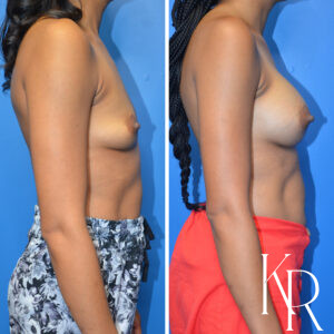 Before and after breast augmentation