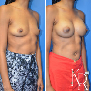 Before and after breast augmentation