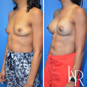 Before and after breast augmentation