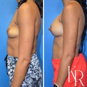 Before and after breast augmentation