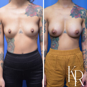Before and after breast augmentation