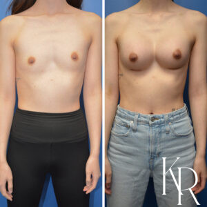 Before and after breast augmentation