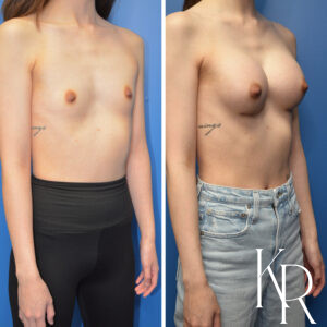 Before and after breast augmentation