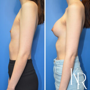 Before and after breast augmentation