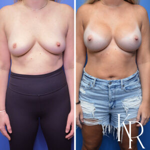 Before and after breast augmentation