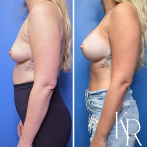 Before and after breast augmentation