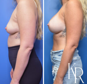 Before and after breast augmentation