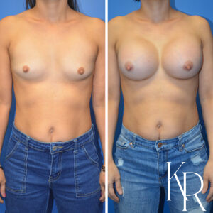 Before and after breast augmentation