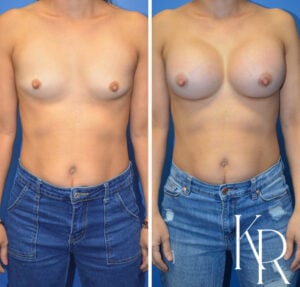 Before and after breast augmentation