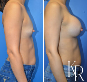 Before and after breast augmentation