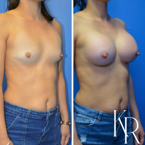 Before and after breast augmentation