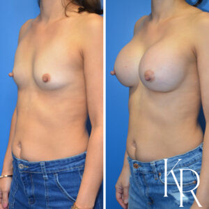 Before and after breast augmentation
