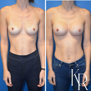 Before and after breast augmentation