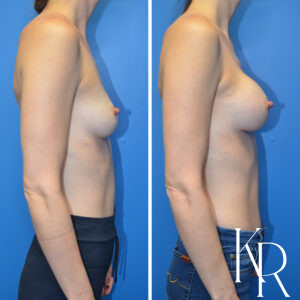 Before and after breast augmentation