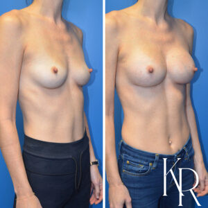 Before and after breast augmentation